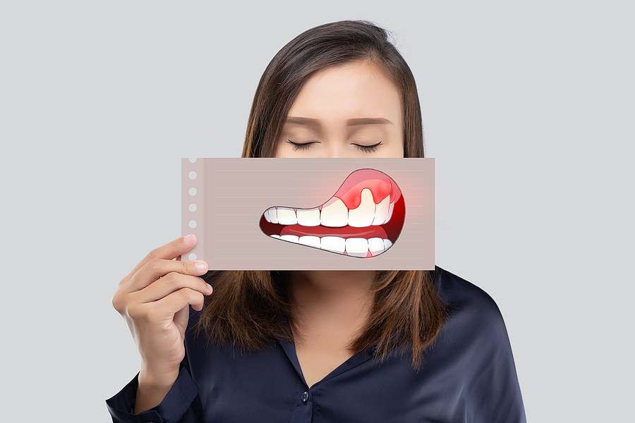 Restore Your Gum Health with Gingival Grafting in Palm Desert, CA