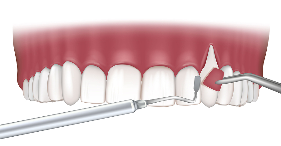 Everything You Need to Know About Gum Grafting in Palm Desert, CA