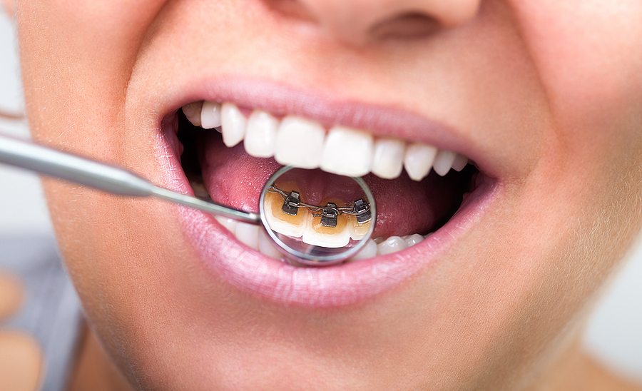 Scaling and Root Planing: The Gold Standard for Treating Gum Disease